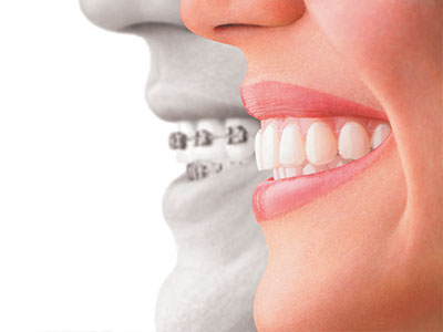 The image shows a split-screen comparison of a person s natural smile on the left with a dental implant on the right, highlighting the difference between the two.