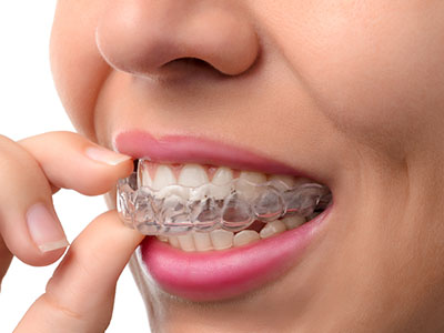 This is a close-up photograph of a person wearing clear braces with a toothbrush in their mouth, showcasing dental hygiene practices.