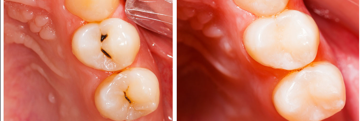 The image shows a close-up view of a dental implant with a visible screw, taken from an angle where the implant appears to be missing a tooth.
