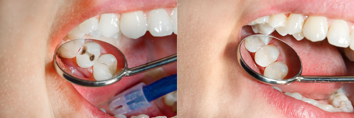 The image shows two photos of a person s mouth with an open toothbrush inside, displaying their teeth and tongue, with a focus on dental hygiene.