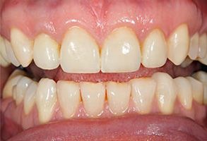 The image shows a close-up view of a person s teeth with visible staining and discoloration, particularly around the gum line, which suggests poor oral hygiene or dental issues.
