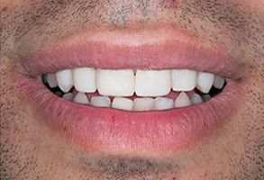 The image shows a close-up of a person s smiling mouth with white teeth, set against a neutral background.