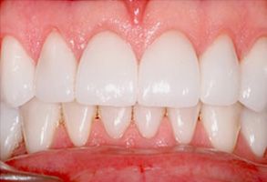The image displays a close-up view of a person s teeth with a focus on dental hygiene, showcasing cleanliness and the process of teeth whitening.