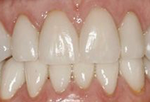 The image shows a close-up of a person s teeth, with a focus on the front row of upper teeth, which appear to be crooked and possibly in need of orthodontic treatment.