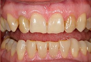 The image shows a close-up view of a person s teeth with visible staining and decay, indicating poor oral hygiene or dental health issues.