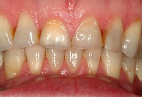 The image shows a close-up view of a person s teeth with significant discoloration and staining, likely due to poor oral hygiene or the use of tobacco products.